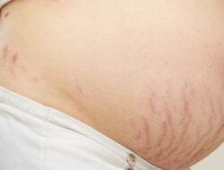 Pregnant women with the following conditions are more susceptible to stretch marks