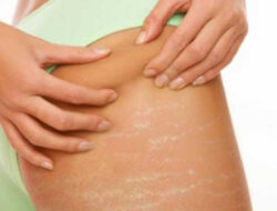 In addition to pregnancy, check out a series of causes for stretch marks